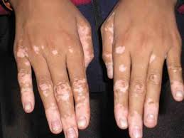 Cara menutupi bercak putih vitiligo